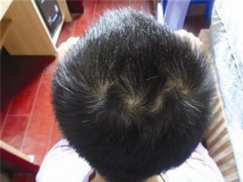 Cha mẹ xem xoáy tóc đỉnh đầu đoán định tương lai con trẻ hình ảnh Cha me xem xoay toc dinh dau doan dinh tuong lai con tre hinh anh