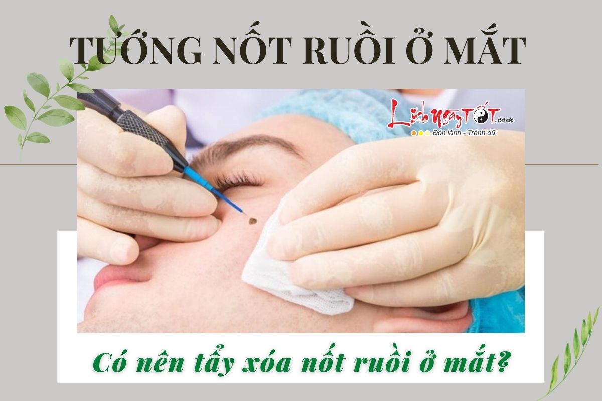 Có nên xóa nốt ruồi ở mắt? Co nen xoa not ruoi o mat?