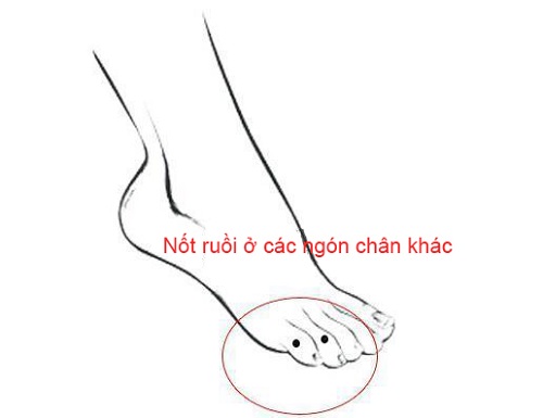 Nốt ruồi ở các ngón chân khác Not ruoi o cac ngon chan khac