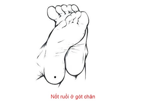 Nốt ruồi ở gót chân Not ruoi o got chan