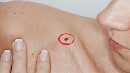 not ruoi o cuoi xuong quai xanh Nốt ruồi cuối xương quai xanh