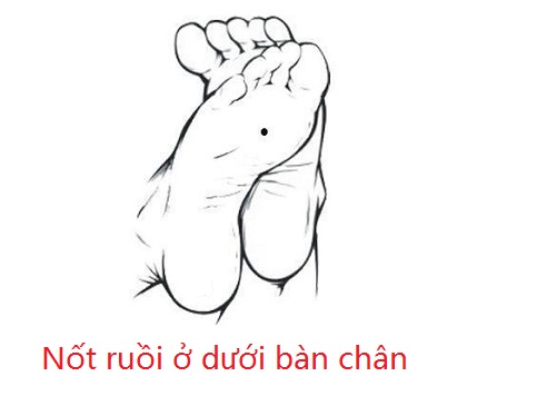Nốt ruồi ở dưới bàn chân nói chung Not ruoi o duoi ban chan noi chung
