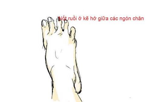 Nốt ruồi ở kẽ chân Not ruoi o ke chan