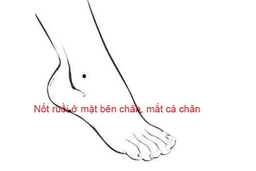Nốt ruồi ở mắt cá chân Not ruoi o mat ca chan