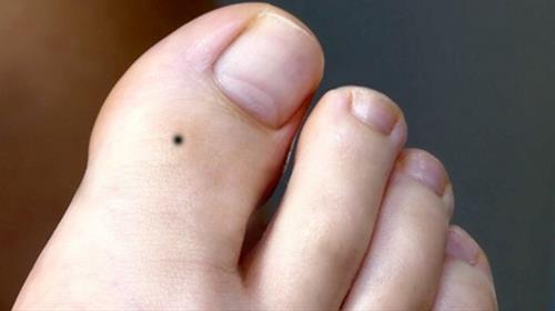not ruoi o ngon chan cai Nốt ruồi ở ngón chân cái