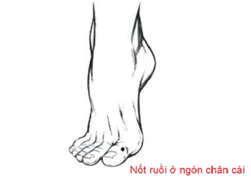 Nốt ruồi ở ngón chân cái Not ruoi o ngon chan cai